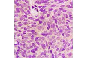 Immunohistochemical analysis of STMN1 staining in human breast cancer formalin fixed paraffin embedded tissue section. (Stathmin 1 抗体  (N-Term))