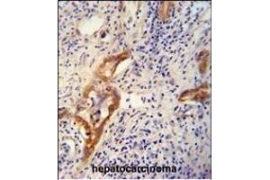 CLPX antibody (C-term) (ABIN654723 and ABIN2844412) immunohistochemistry analysis in formalin fixed and paraffin embedded human hepatocarcinoma followed by peroxidase conjugation of the secondary antibody and DAB staining. (CLPX 抗体  (C-Term))