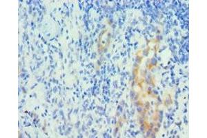 Immunohistochemistry of paraffin-embedded human lung cancer using ABIN7150963 at dilution of 1:100 (PIAS1 抗体  (AA 422-651))