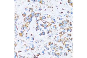 Immunohistochemistry of paraffin-embedded human breast cancer using C antibody (ABIN7266074) at dilution of 1:100 (40x lens). (CA13 抗体  (AA 1-220))