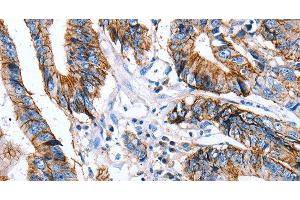 Immunohistochemistry of paraffin-embedded Human colon cancer using Claudin 7 Polyclonal Antibody at dilution of 1:50 (Claudin 7 抗体)