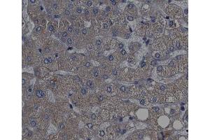 ABIN6267439 at 1/200 staining human liver cancer tissue sections by IHC-P. (RPS6KB1 抗体  (pThr389, pThr412))