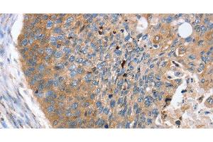 Immunohistochemistry of paraffin-embedded Human esophagus cancer using REG3A Polyclonal Antibody at dilution of 1:40 (REG3A 抗体)