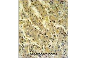 PSG7 Antibody (C-term) (ABIN651132 and ABIN2840089) IHC analysis in formalin fixed and paraffin embedded hepatocarcinoma followed by peroxidase conjugation of the secondary antibody and DAB staining. (PSG7 抗体  (C-Term))