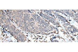 Immunohistochemistry of paraffin-embedded Human thyroid cancer tissue using UPK3A Polyclonal Antibody at dilution of 1:30(x200) (Uroplakin 3A 抗体)