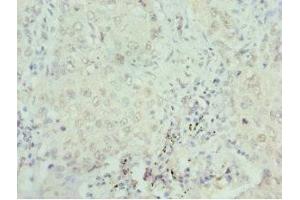 Immunohistochemistry of paraffin-embedded human lung cancer using ABIN7168762 at dilution of 1:100 (SEPHS1 抗体  (AA 1-392))