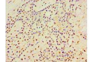 Immunohistochemistry of paraffin-embedded human breast cancer using ABIN7169355 at dilution of 1:100 (SRRT 抗体  (AA 627-876))