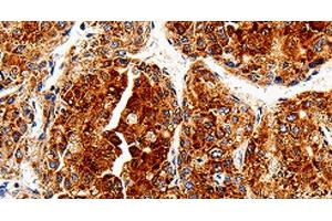 Immunohistochemistry of paraffin-embedded Human liver cancer tissue using COX19 Polyclonal Antibody at dilution 1:50 (COX19 抗体)