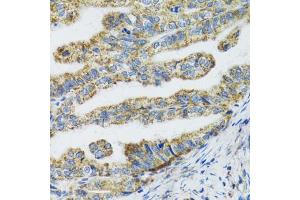 Immunohistochemistry of paraffin-embedded human gastric cancer using TXN2 antibody (ABIN5974110) at dilution of 1/100 (40x lens). (TXN2 抗体)