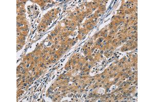 Immunohistochemistry of Human gastric cancer using COPB1 Polyclonal Antibody at dilution of 1:50 (COPB1 抗体)