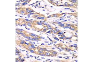 Immunohistochemistry of paraffin-embedded human colon carcinoma using TXN2 antibody at dilution of 1:100 (x40 lens). (TXN2 抗体)