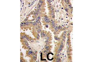 Formalin-fixed and paraffin-embedded human lung carcinoma tissue reacted with BAD polyclonal antibody  , which was peroxidase-conjugated to the secondary antibody, followed by DAB staining. (BAD 抗体  (Internal Region))