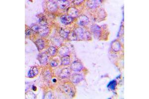 Immunohistochemical analysis of ACAT1 staining in human lung cancer formalin fixed paraffin embedded tissue section. (ACAT1 抗体  (Center))