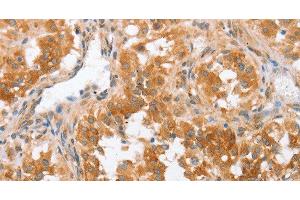 Immunohistochemistry of paraffin-embedded Human thyroid cancer using CRELD2 Polyclonal Antibody at dilution of 1:50 (CRELD2 抗体)