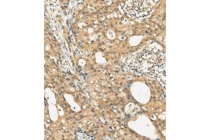 (ABIN392009 and ABIN2837977) staining c-KIT in human breast carcinoma tissue sections by Immunohistochemistry (IHC-P - paraformaldehyde-fixed, paraffin-embedded sections). (KIT 抗体  (AA 912-941))