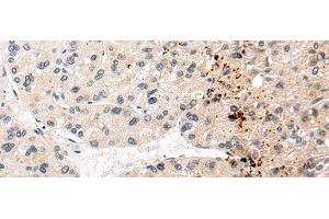 Immunohistochemistry of paraffin-embedded Human liver cancer tissue using AQP11 Polyclonal Antibody at dilution 1:30 (AQP11 抗体)