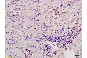 Formalin-fixed and paraffin embedded human gastric carcinoma labeled with Anti-MSK1/RPS6KA5 Polyclonal Antibody, Unconjugated  at 1:200 followed by conjugation to the secondary antibody and DAB staining. (Msk1/2 (AA 49-94) 抗体)