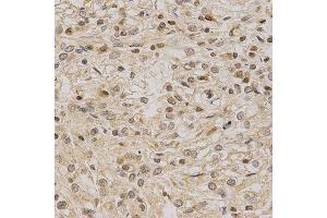 Immunohistochemistry of paraffin-embedded human kidney cancer using LETMD1 antibody at dilution of 1:200 (x40 lens) (LETMD1 抗体)