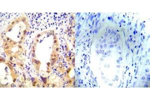 Immunohistochemical analysis of paraffin-embedded human lung carcinoma tissue using P53 (phospho-Ser37) antibody (E012031). (p53 抗体  (pSer37))