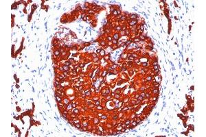 Formalin-fixed, paraffin-embedded human Breast Carcinoma stained with Cytokeratin, pan Monoclonal Antibody cocktail (KRTL/1077 + KRTH/1076). (KRT77, KRT76 抗体)