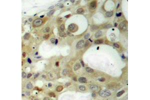 Immunohistochemistry of paraffin-embedded human breast carcinoma using Phospho-AR-S650 antibody (ABIN2987884). (Androgen Receptor 抗体  (pSer650))