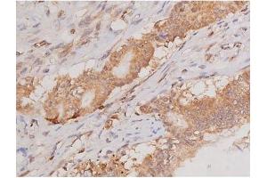 ABIN6269133 at 1/200 staining Human colon cancer tissue sections by IHC-P. (KIT 抗体  (Internal Region))