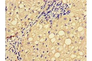 Immunohistochemistry of paraffin-embedded human liver cancer using ABIN7151827 at dilution of 1:100 (EPHA1 抗体  (AA 296-414))