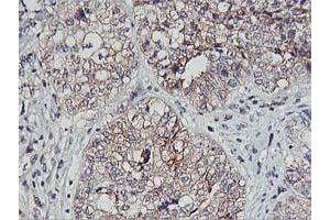 Immunohistochemical staining of paraffin-embedded Adenocarcinoma of Human ovary tissue using anti-PDSS2 mouse monoclonal antibody. (PDSS2 抗体)