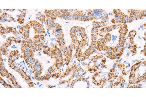 Immunohistochemistry of paraffin-embedded Human thyroid cancer using ATPIF1 Polyclonal Antibody at dilution of 1:50 (ATPase Inhibitory Factor 1 抗体)