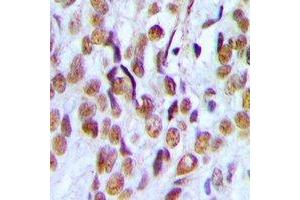 Immunohistochemical analysis of PHF19 staining in human ovarian cancer formalin fixed paraffin embedded tissue section. (PHF19 抗体)