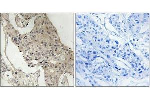 Immunohistochemical analysis of paraffin-embedded human breast carcinoma tissue using Gab2 (Phospho-Ser623) antibody (left)or the same antibody preincubated with blocking peptide (right). (GAB2 抗体  (pSer623))