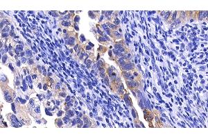 Detection of MMP7 in Human Endometrial cancer Tissue using Polyclonal Antibody to Matrix Metalloproteinase 7 (MMP7) (MMP7 抗体  (AA 1-267))