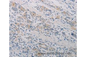 Immunohistochemistry of Human gastic cancer using PTAFR Polyclonal Antibody at dilution of 1:70 (PTAFR 抗体)
