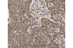 Immunohistochemistry of Human lung cancer using IL15RA Polyclonal Antibody at dilution of 1:45 (IL15RA 抗体)