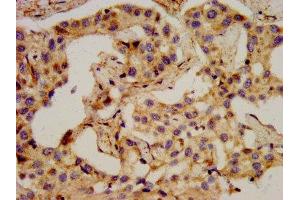 IHC image of ABIN7161261 diluted at 1:400 and staining in paraffin-embedded human liver cancer performed on a Leica BondTM system. (PCSK2 抗体  (AA 267-391))