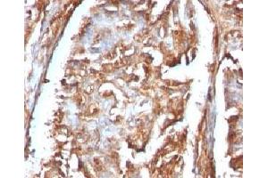 Formalin-fixed, paraffin-embedded human renal carcinoma stained with Beta-2-Microglobulin antibody. (beta-2 Microglobulin 抗体)