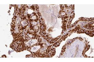 ABIN6267216 at 1/100 staining Human thyroid cancer tissue by IHC-P. (WIPI2 抗体  (C-Term))