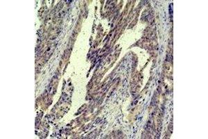 Immunohistochemical analysis of c-Jun staining in human breast cancer formalin fixed paraffin embedded tissue section. (C-JUN 抗体)