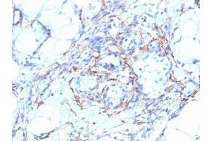 Formalin-fixed, paraffin-embedded human angiosarcoma stained with SMMHC antibody (MYH11/923 + SMMS-1). (MYH11 抗体)