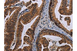 The image on the left is immunohistochemistry of paraffin-embedded Human gastric cancer tissue using ABIN7191352(MAGEB3 Antibody) at dilution 1/20, on the right is treated with synthetic peptide. (MAGEB3 抗体)