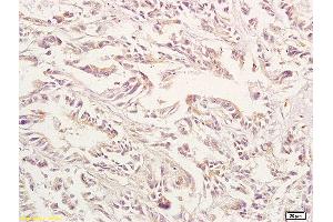 Formalin-fixed and paraffin embedded human gastric carcinoma labeled with Anti-GPA33 Polyclonal Antibody, Unconjugated (ABIN673644) at 1:200 followed by conjugation to the secondary antibody and DAB staining. (GPA33 抗体  (AA 151-280))