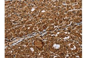 The image on the left is immunohistochemistry of paraffin-embedded Human thyroid cancer tissue using ABIN7192693(STMN2/STMN3/STMN4 Antibody) at dilution 1/45, on the right is treated with synthetic peptide. (STMN2/STMN3/STMN4 抗体)