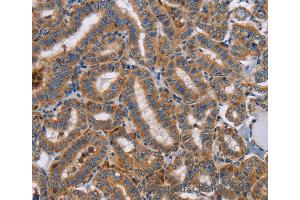 Immunohistochemistry of Human colon cancer using TLR8 Polyclonal Antibody at dilution of 1:40 (TLR8 抗体)