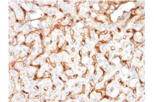 Formalin-fixed, paraffin-embedded human Hepatocellular Carcinoma stained with C1QB Mouse Monoclonal Antibody (C1QB/2965). (C1QB 抗体  (AA 41-188))
