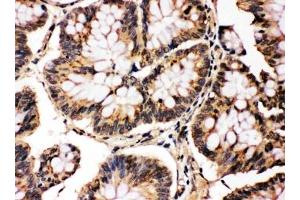 IHC testing of FFPE human intestinal cancer with MAPK8/9 antibody. (MAPK8 / MAPK9 (Middle Region) 抗体)