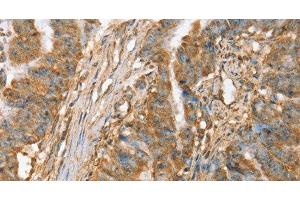 Immunohistochemistry of paraffin-embedded Human esophagus cancer tissue using SLC41A2 Polyclonal Antibody at dilution 1:45 (SLC41A2 抗体)