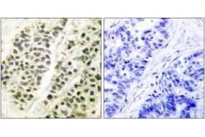 Immunohistochemistry analysis of paraffin-embedded human breast carcinoma tissue, using DNA Polymerase beta Antibody.