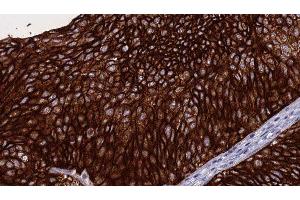 ABIN6276284 at 1/100 staining Human urothelial cancer tissue by IHC-P. (Perforin 1 抗体  (N-Term))