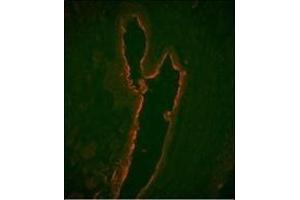 Immunofluorescence analysis of LTF Monoclonal Antibody with paraffin-embedded human prostate carcinoma tissue. (Lactoferrin 抗体)