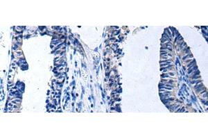 Immunohistochemistry of paraffin-embedded Human prost at e cancer tissue using PROC Polyclonal Antibody at dilution of 1:80(x200) (PROC 抗体)